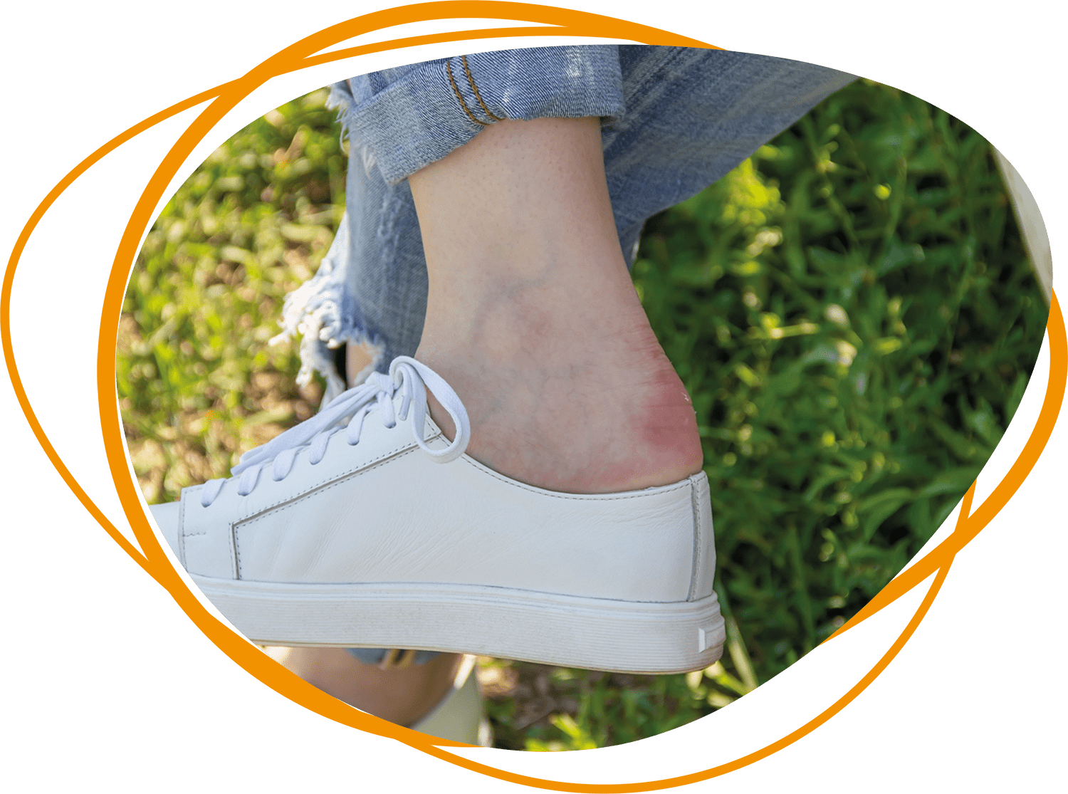 Header Blog - Alles wat je moet weten over blaren